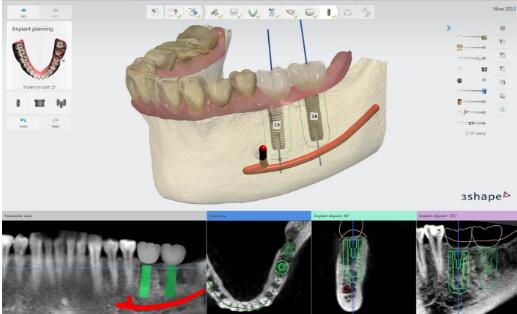 3Shape Implant Studio