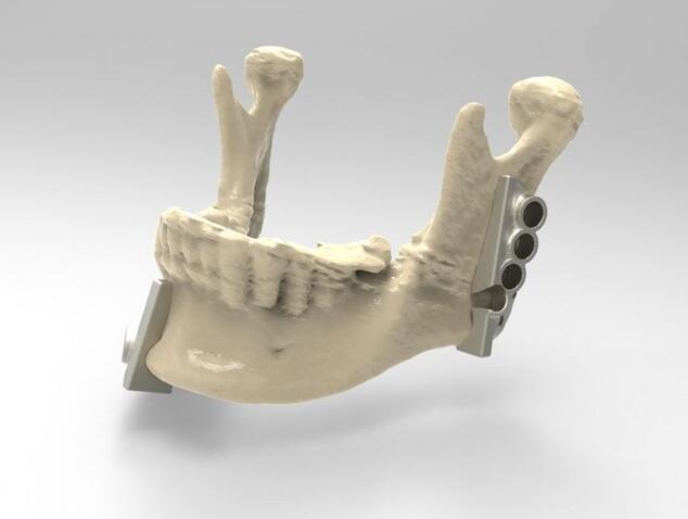 3D打印钛合金手术导板辅助下颌骨重建手术